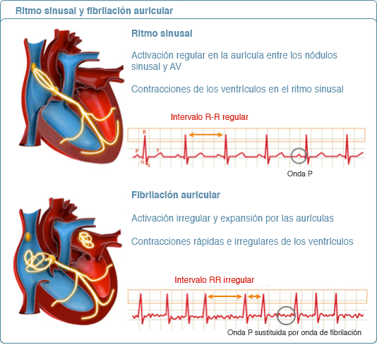 diferencia entre ventricula y auricula